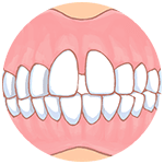 すきっ歯で悩んでいる 空隙歯列